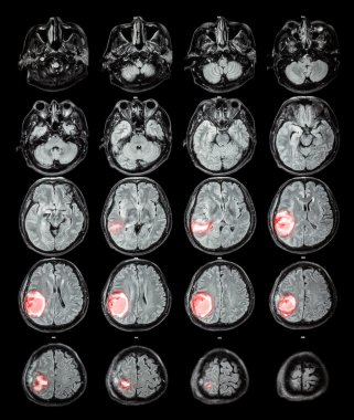 MRI beyin: beyin tümörü, sağ parietal LOB