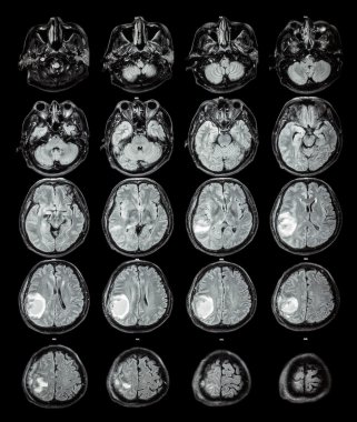 MRI beyin: beyin tümörü, sağ parietal LOB