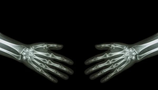 Shake hands .  X-ray normal human hands   ( blank area at upper side ) — Stock Photo, Image