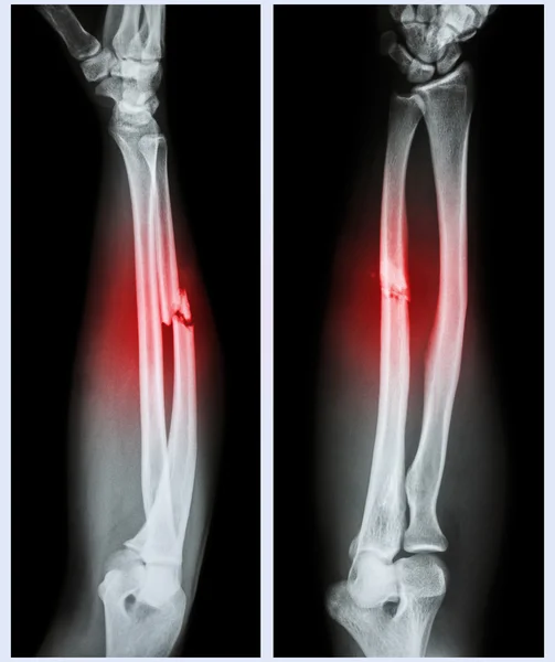 Eixo de fractura cominuto do osso ulnar — Fotografia de Stock