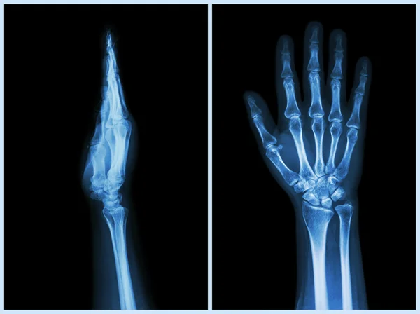 Mani a raggi X (vista frontale e laterale): normali mani umane — Foto Stock