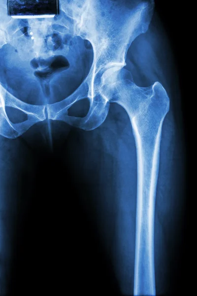 Normal pelvis & hip joint — Stock Photo, Image