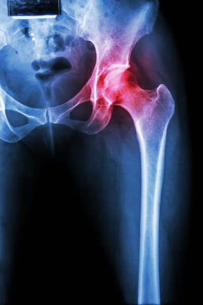 Arthritis at hip joint — Stock Photo, Image