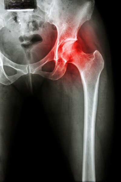 Arthritis at hip joint 