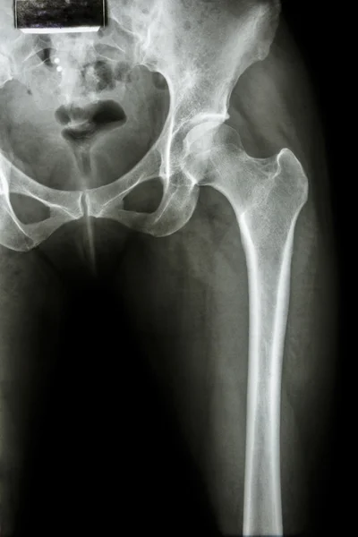 Pelvis normal y articulación de cadera — Foto de Stock