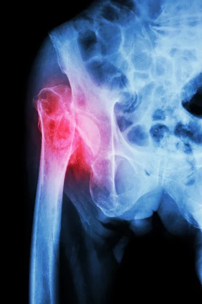 Whiplash X Ray Stock Photos Royalty Free Whiplash X Ray Images