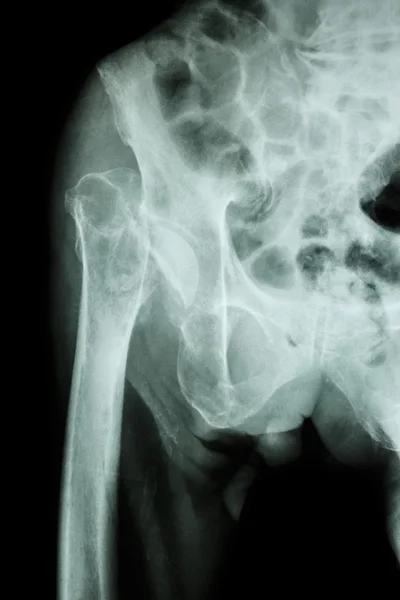 Šéf zlomenina stehenní kosti (stehenní kost) — Stock fotografie
