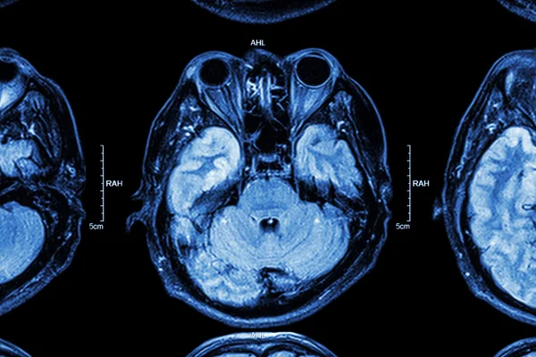 Close up of MRI brain: Parte inferior do cérebro (olhos, temporal lo — Fotografia de Stock