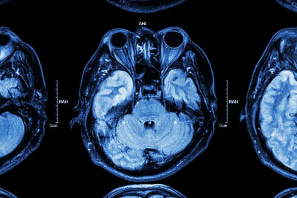 Close up of MRI brain : Lower part of brain ( eyes , temporal lo — Stock Photo, Image