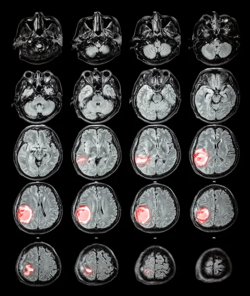 RM cerebral: tumor cerebral en el lóbulo parietal derecho —  Fotos de Stock