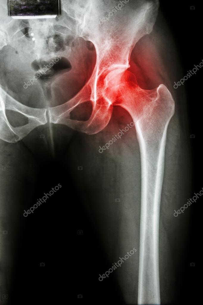 Arthritis at hip joint Stock Photo by ©stockdevil_666 61592849