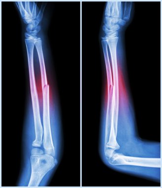 Ulnar kemiğin kırık mili ( önkol kemiği ) : ( ön ve yan görünüm )