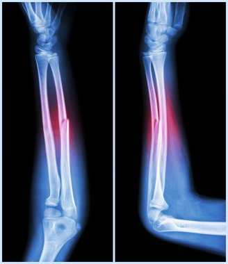 Fracture shaft of ulnar bone ( forearm bone )  :  ( front and side view ) clipart