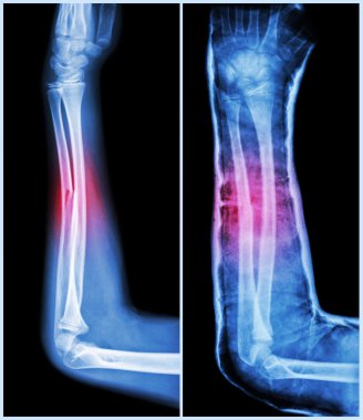 Ulnar kemiğin kırık şaftı ( önkol kemiği ) : ( Sol : ön tedavi , Sağ : Psot-treatment (döküm ile splint) )