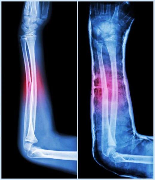 Eje de fractura del hueso cubital (hueso del antebrazo): (Izquierda: pretratamiento, Derecha: Psot-tratamiento (férula con yeso ) ) — Foto de Stock