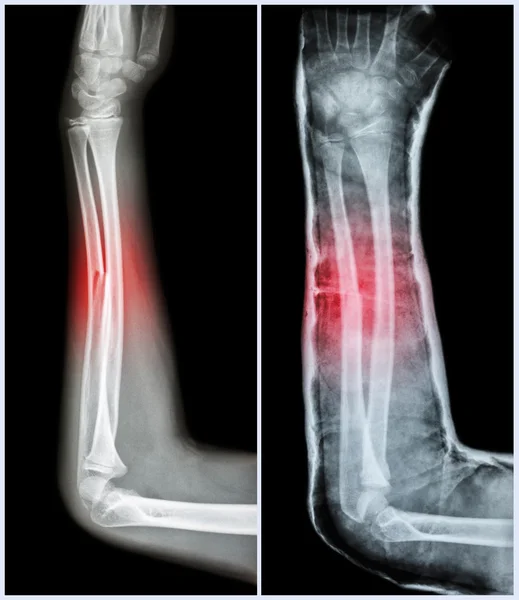 Eje de fractura del hueso cubital (hueso del antebrazo): (Izquierda: pretratamiento, Derecha: Psot-tratamiento (férula con yeso ) ) — Foto de Stock