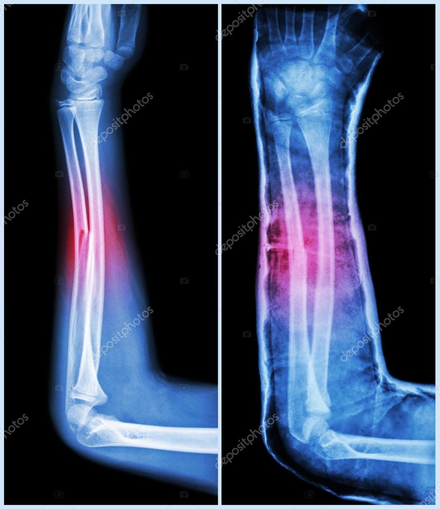 Fracture Shaft Of Ulnar Bone Forearm Bone Left Pre