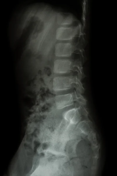 Οσφυϊκή μοίρα της σπονδυλικής στήλης του παιδιού (ακτινογραφία θώρακα - οσφυϊκή μοίρα της σπονδυλικής στήλης) (πλάγια προβολή ) — Φωτογραφία Αρχείου