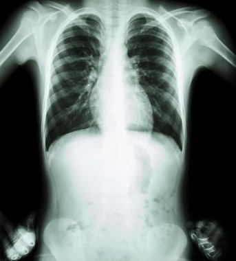 X-ray göğüs (akimbo konumu) (ön görünüm) )