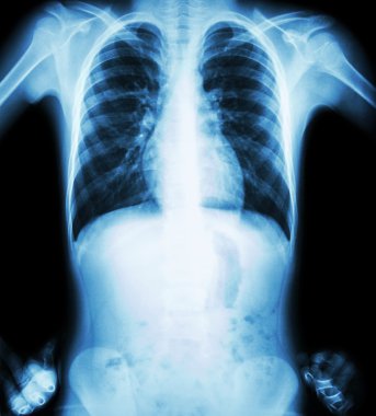 X-ray göğüs (akimbo konumu) (ön görünüm) )