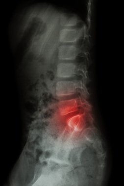 Lomber omurgada çocuk ve lomber omurgada iltihap ( bel ağrısı ) ( X-Ray torasik - lomber omurga ) ( lateral görünüm )