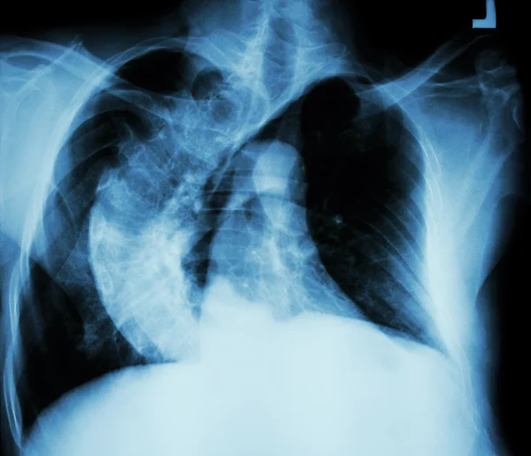 Scoliosi (colonna vertebrale storta) Torace a raggi X di persone anziane con croo — Foto Stock