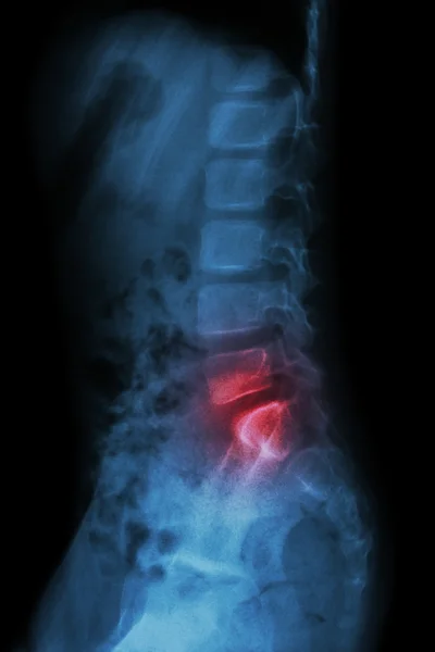 Lumbar spine of child and inflammation at lumbar spine ( low back pain ) ( X-ray thoracic - lumbar spine ) ( lateral view ) — Stock Photo, Image