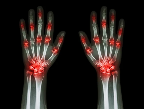 Artrite articular múltipla ambas as mãos (gota, reumatóide) no fundo preto — Fotografia de Stock