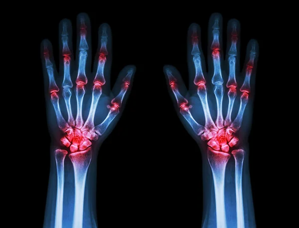 Multiple joint arthritis both hands ( Gout , Rheumatoid ) on black background — Stock Photo, Image