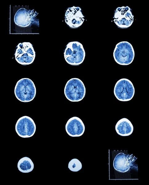CT scan (computed tomography) of normal brain ( cerebrovascular — Stock Photo, Image