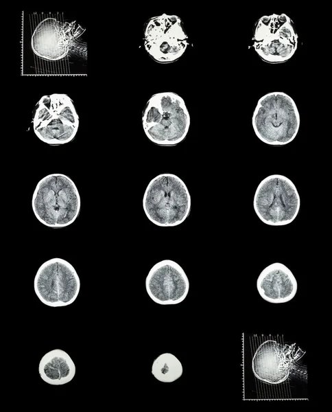Tomografía computarizada (TC) del cerebro normal (cerebrovascular) — Foto de Stock