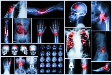 X-ray multiple disease (Stroke (cerebrovascular accident) : cva ,Pulmonary tuberculosis ,Bone fracture ,Shoulder dislocation ,Gout ,Rheumatoid arthritis ,Spondylosis ,Osteoarthritis ,Bowel obstruction clipart