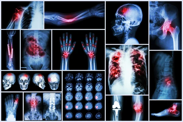 X 射线多疾病 (中风 (脑血管意外): cva、 肺结核、 骨骨折、 肩关节脱位，痛风，类风湿性关节炎、 颈椎病、 骨关节炎，肠梗阻 — 图库照片