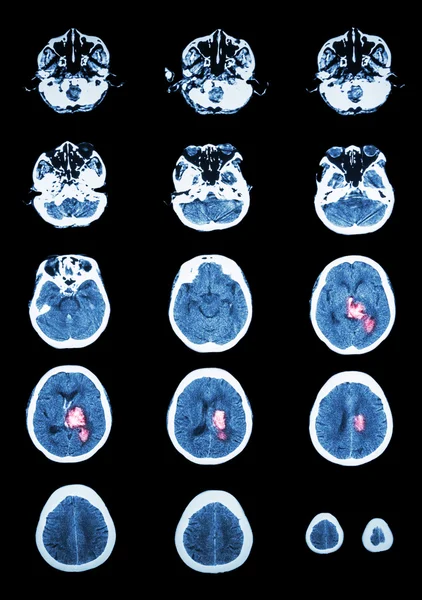 Acidente vascular cerebral hemorrágico. TC (tomografia computadorizada) do cérebro (c — Fotografia de Stock