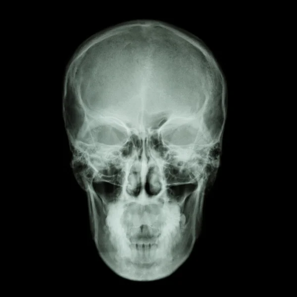 X-ray skull and Stroke ( cerebrovascular accident (CVA) ) — Stock Photo, Image