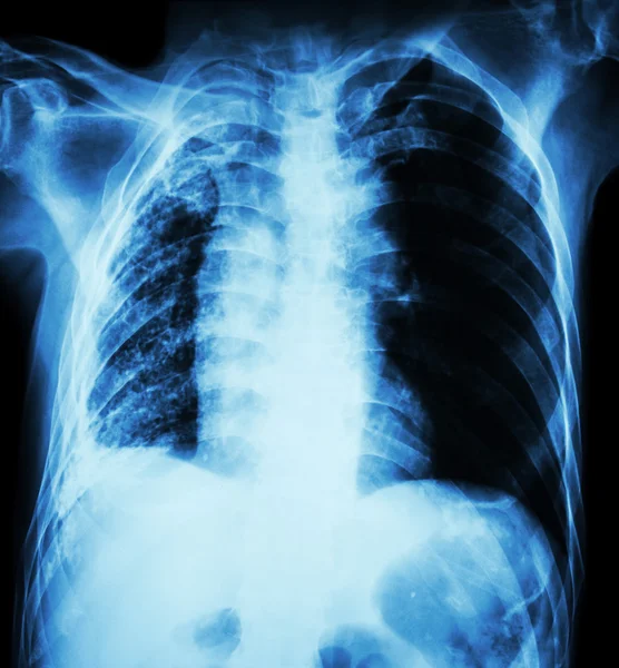 Tuberculosis pulmonar. Radiografía de tórax: atelectasia pulmonar derecha — Foto de Stock