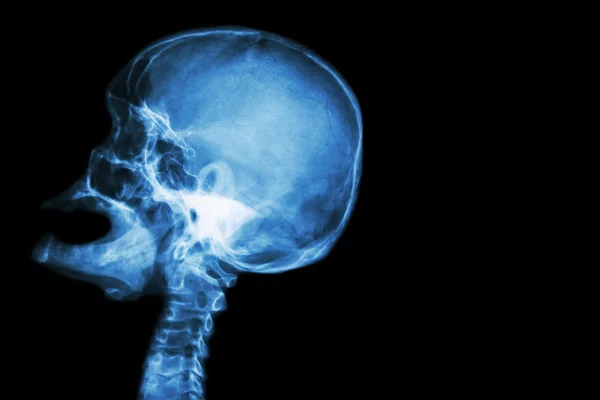 Caveira de raios-X boca aberta (vista lateral) e acidente vascular cerebral (AVC) e área em branco no lado direito — Fotografia de Stock