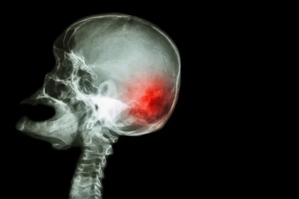 Cranio a raggi X bocca aperta (vista laterale) e ictus (incidente cerebrovascolare (CVA)) e area vuota sul lato destro — Foto Stock