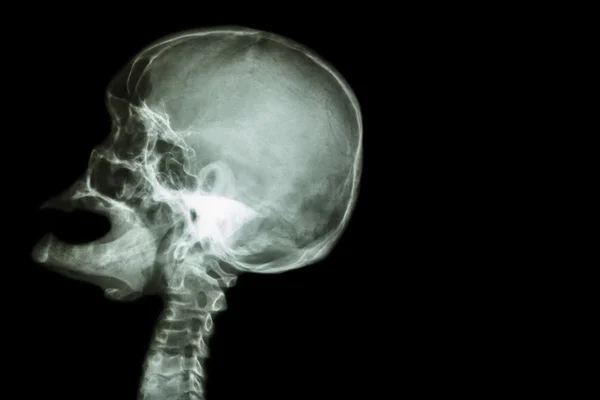 Cranio a raggi X bocca aperta (vista laterale) e ictus (incidente cerebrovascolare (CVA)) e area vuota sul lato destro — Foto Stock