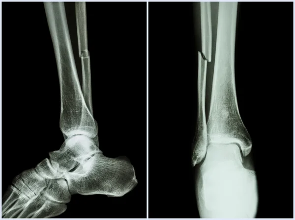 Eje de fractura del hueso del peroné (hueso de la pierna). Radiografía de la pierna (2 posiciones: vista lateral y frontal  ) —  Fotos de Stock