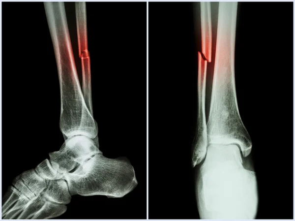 Eje de fractura del hueso del peroné (hueso de la pierna). Radiografía de la pierna (2 posiciones: vista lateral y frontal  ) — Foto de Stock