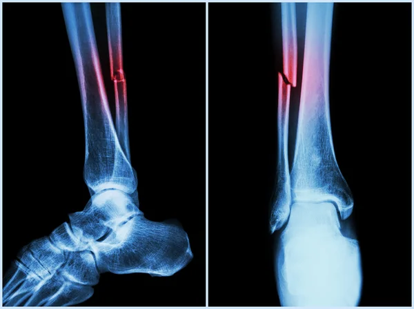 Eje de fractura del hueso del peroné (hueso de la pierna). Radiografía de la pierna (2 posiciones: vista lateral y frontal  ) — Foto de Stock