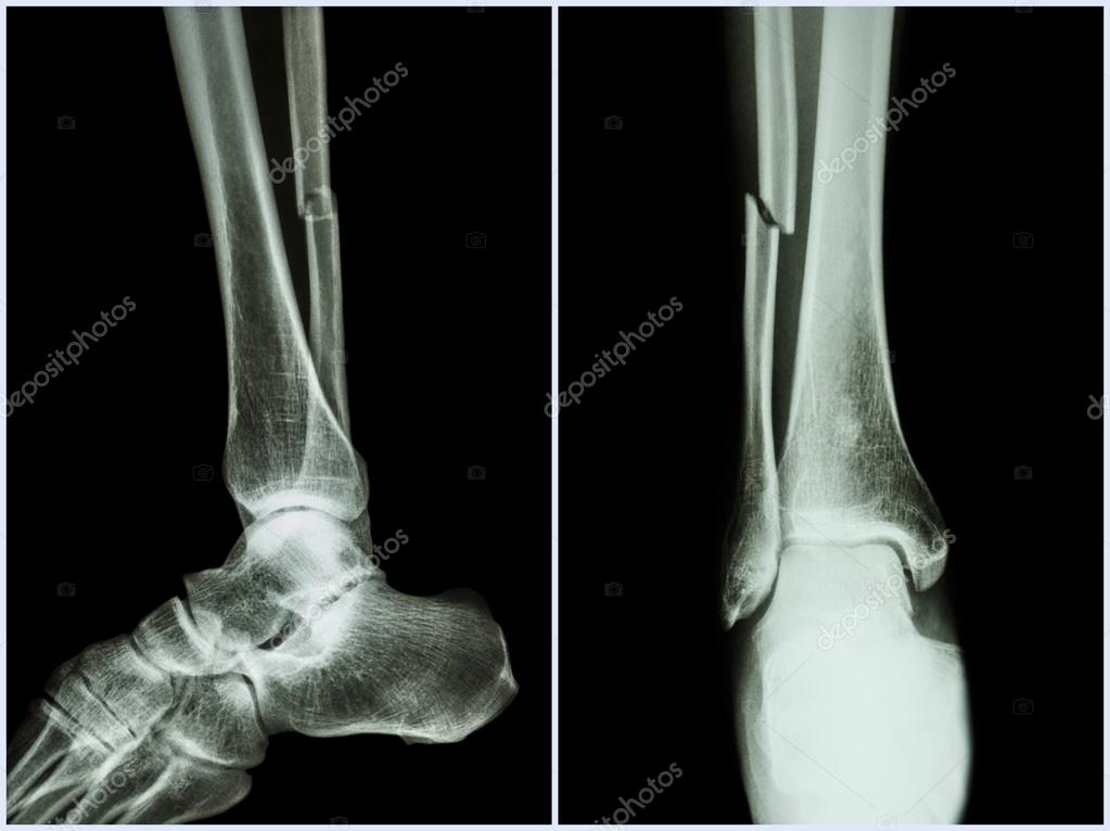 Arbre de fracture de l'os du péroné (os de la jambe). Rayon X de ...