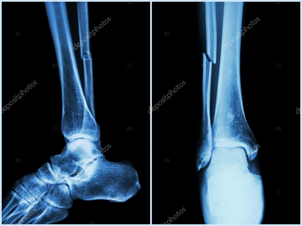 Fracture shaft of fibula bone ( leg bone ) . Xray of leg ( 2 position side and front view