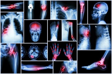 Koleksiyon x-ışını birden çok hastalık (inme, kırık, osteoartrit, pnömoni, tüberküloz, spondiloz, spondilolistezis, gut, romatoid artrit, beyin tümörü, ortopedik operasyon, vb)