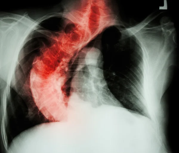 Сколиоз (кривой позвоночник) рентген груди пожилых людей с кроо — стоковое фото