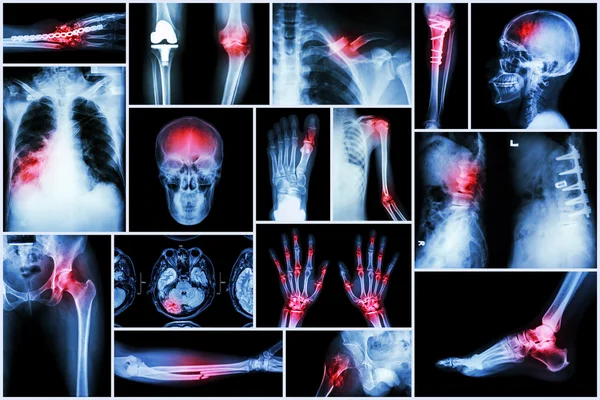 Collectie X-ray meerdere ziekte (lijn, breuk, artrose, longontsteking, tuberculose, gespecialiseerd, spondylolisthesis, jicht, reumatoïde artritis, hersentumor, orthopedische operatie, enz) — Stockfoto