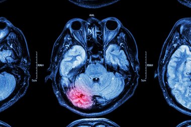 MRI of brain : brain injury clipart