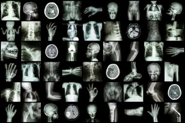 Yetişkin ve çocuk ve hastalıkları (akciğer tüberkülozu felç böbrek taşı osteoartrit kemik kırığı bağırsak tıkanıklığı spondiloz spondilolistezis skolyoz beyin tümörü vb çoklu bölüm x-ışını)