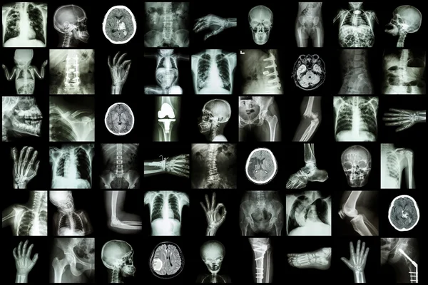 Raio-X parte múltipla de adulto e criança e doença (tuberculose pulmonar acidente vascular cerebral osteoartrite fratura óssea obstrução intestinal espondilolistese escoliose tumor cerebral etc ) — Fotografia de Stock